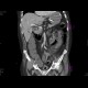 Necrotizing enterocolitis, gas in portal vein: CT - Computed tomography